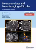 Neurosonology And Neuroimaging Of Stroke